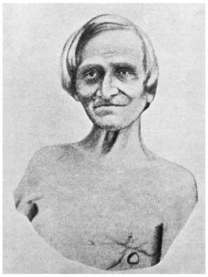 Alexis St. Martin recibió un tiro y su caso se hizo famoso. LIBRARY OF CONGRESS/SCIENCE PHOTO LIBRARY