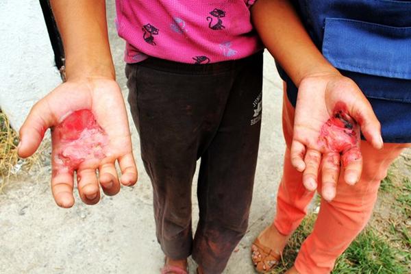 Una de las menores rescatadas en San Martín Zapotitlán, Retalhuleu, sufrió quemaduras en las manos. (Foto Rolando Miranda)