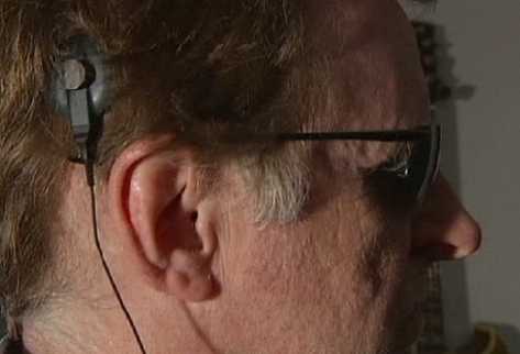 A la izquierda se observa cómo queda la parte externa del chip sobre el cuero cabelludo. A la derecha, una radiografía que  muestra la ubicación del microchip.