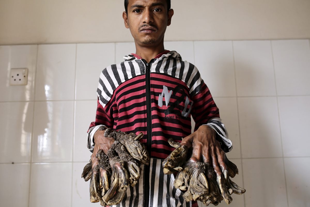 Abul Bajandar, de 26 años y oriundo de una pequeña aldea de la provincia meridional de Khulna, muestra la afección en sus manos. (Foto Prensa Libre: EFE).