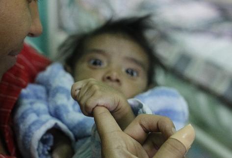 Niños con desnutrición aguda son atendidos en centros de recuperación nutricional en el país.