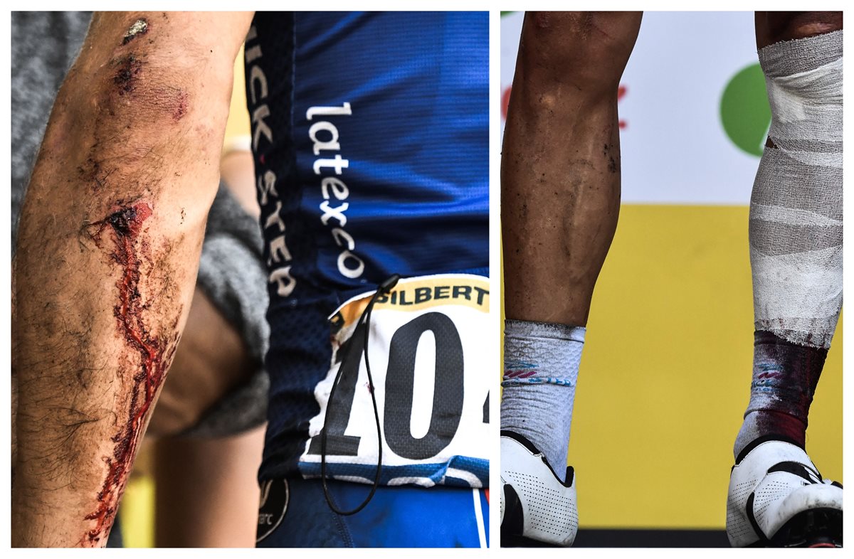 Los golpes evidentes del ciclista Philippe Gilbert. (Foto Prensa Libre: AFP)