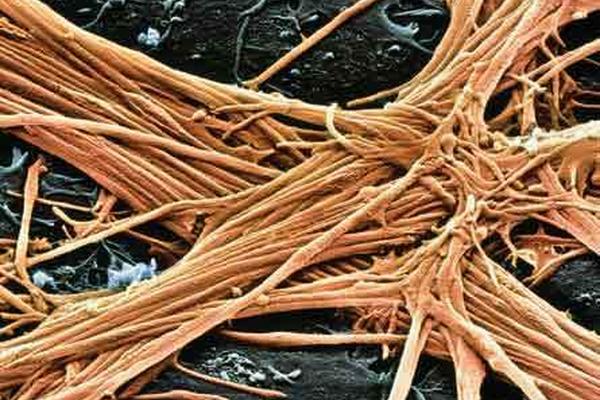 Científicos identificaron una forma de revertir el daño causado en el sistema nervioso por la esclerosis múltiple.