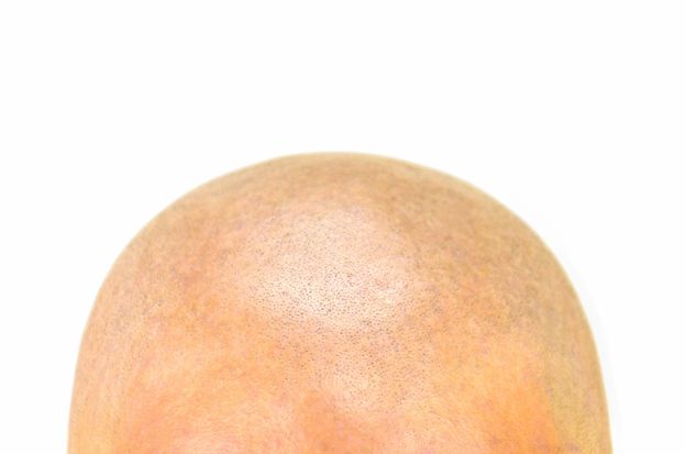 Afeitar la cabeza puede dañar el cuero cabelludo. GETTY IMAGES