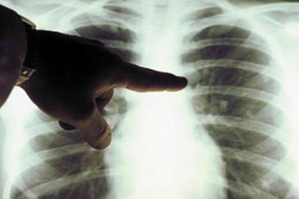 La  pérdida de función de un gen es lo que podría causar metástasis de cáncer de mama a pulmón.