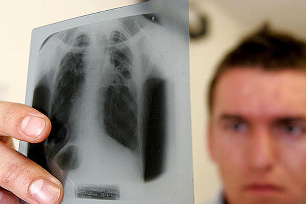 Hasta este año van 537 casos de niños con tuberculosis.  (Foto Prensa Libre: Hemeroteca PL)