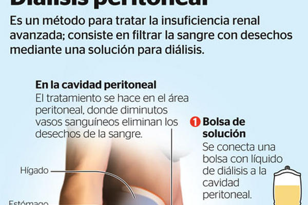 Infografía diálisis peritoneal.<br _mce_bogus="1"/>