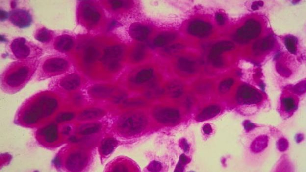 Las posibilidades de que los portadores brasileños de este gen desarrollen cáncer es diferente que en otros lugares del mundo. GETTY IMAGES