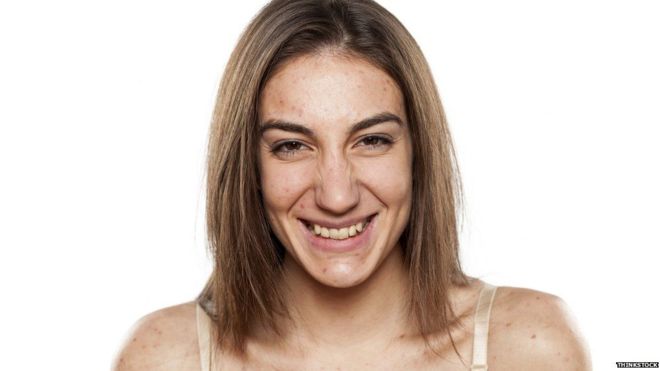 La consulta al médico es más frecuente y precoz en las mujeres que en los hombres, en una proporción que varía entre el 70% y el 80%, según el Grupo Latinoamericano de Estudio del Acné. (Foto Thinkstock)