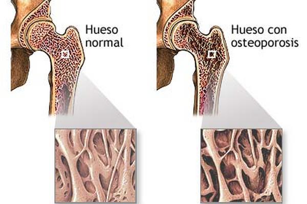 Un test sanguíneo puede identificar riesgo de osteoporosis en mujeres posmenopáusicas