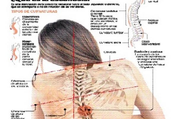 La deformación de la columna puede corregirse si se detecta a tiempo.