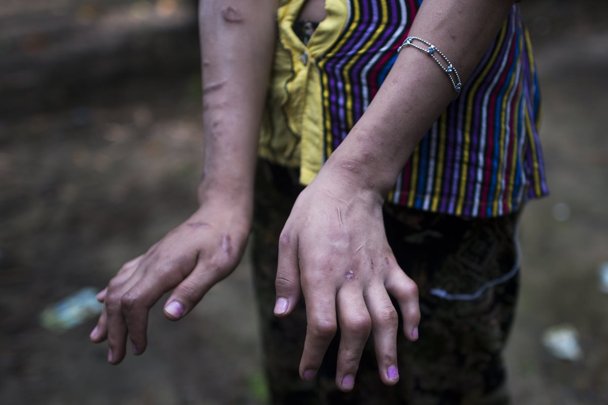 San Kay Khine, un adolescente de 17 años, muestra las cicatrices que dejó en sus manos su etapa como esclavo en Birmania. (Foto Prensa Libre: AFP).