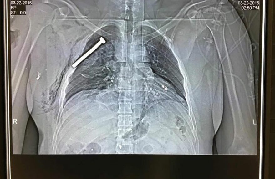 La radiografía de uno de los heridos muestra un tornillo incrustado en uno de sus pulmones. (Foto Prensa Libre: EFE).