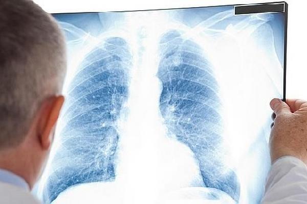 enfermedades pulmonares podrían tratarse con la regeneración de células madre.