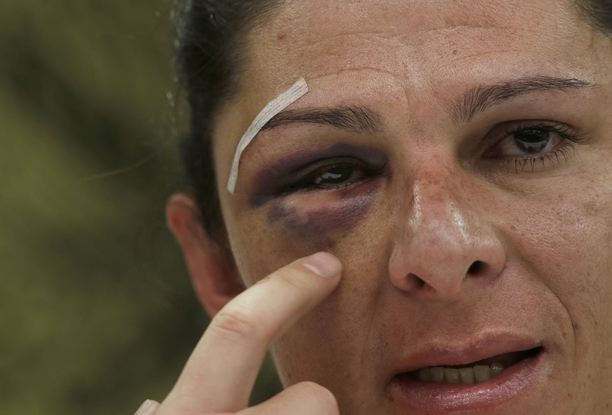 La senadora Ana Gabriela Guevara y exmedallista olímpica de México muestra a la Prensa las huellas de los golpes que recibió. (Foto Prensa Libre: AP).