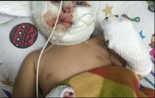 Maryori Elizabeth Pérez de 1 año y 5 meses necesita de manera urgente transplante de piel. (Foto Prensa Libre: Cortesía M. Quintero)