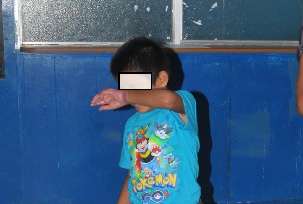 Menor que sufrió la agresión, en Coatepeque, Quetzaltenango. (Foto Prensa Libre: Alexánder Coyoy).