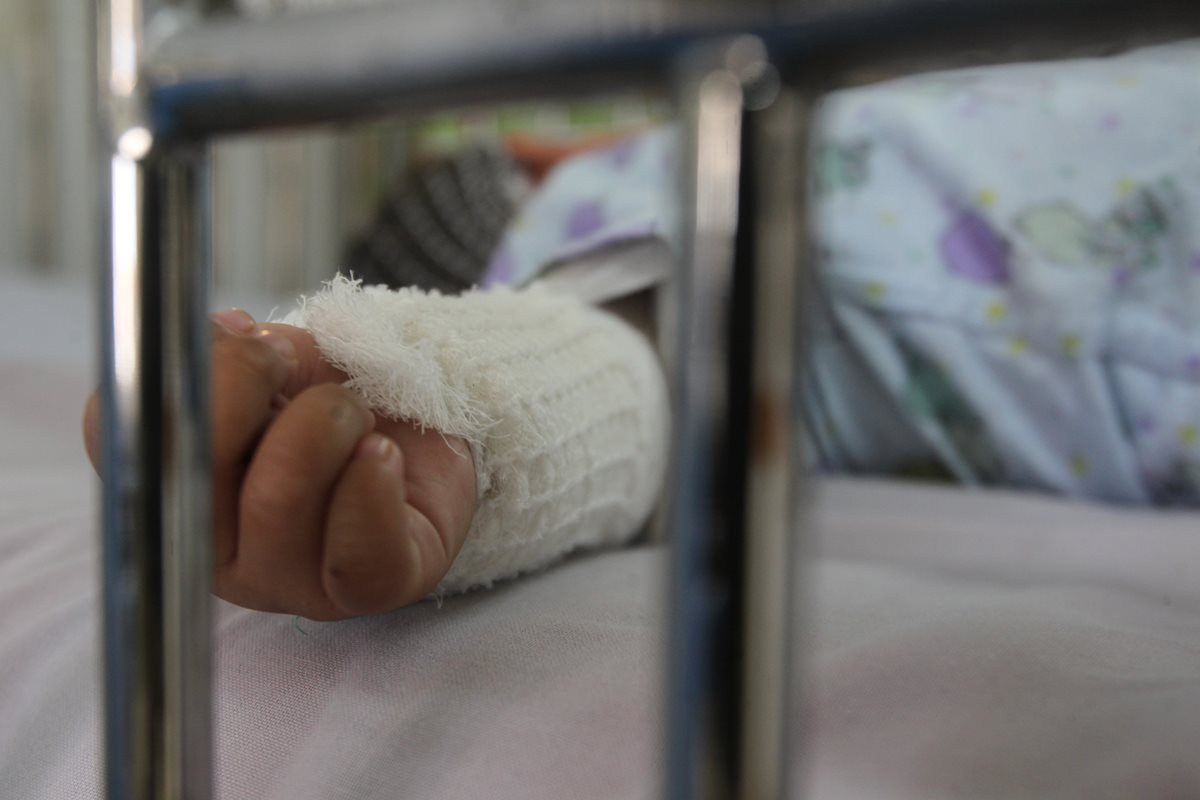 Unidad de quemados del hospital Roosevelt atiende casos de accidentes donde las víctimas son niños. (Foto Prensa Libre: Hemeroteca PL)