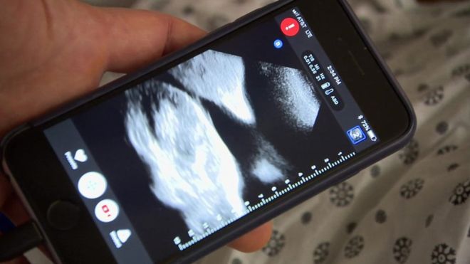Hacerse ecografías a través del celular ya es posible gracias a este invento. (Foto Prensa Libre: BBC)