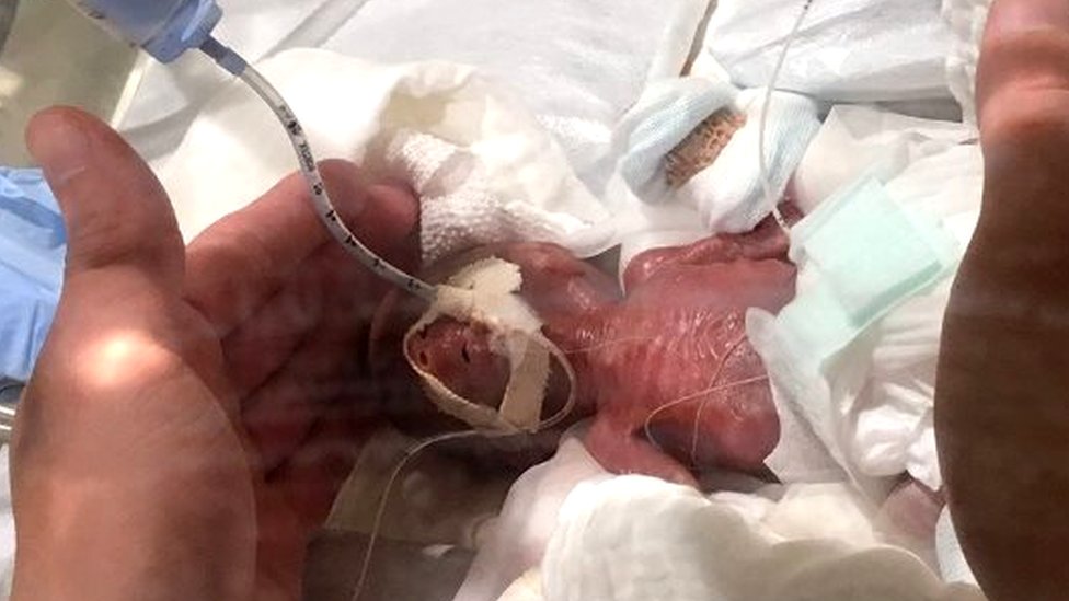 En esta imagen el bebé tenía cinco días de nacido. NO USAR / BBC