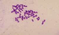 Los cromosomas de un paciente con síndrome de Turner, una enfermedad que solo afecta a las niñas (GETTY IMAGES) 