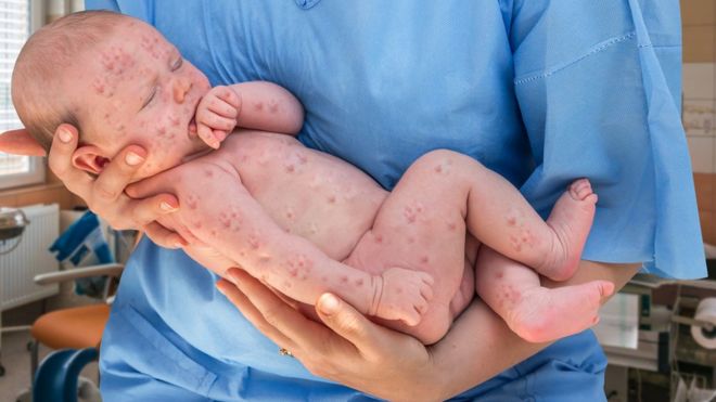 Un descenso en las personas vacunadas es una de las causas para la aparición de nuevos brotes del sarampión, advirtió la OMS. (Foto Prensa Libre: Getty Images)