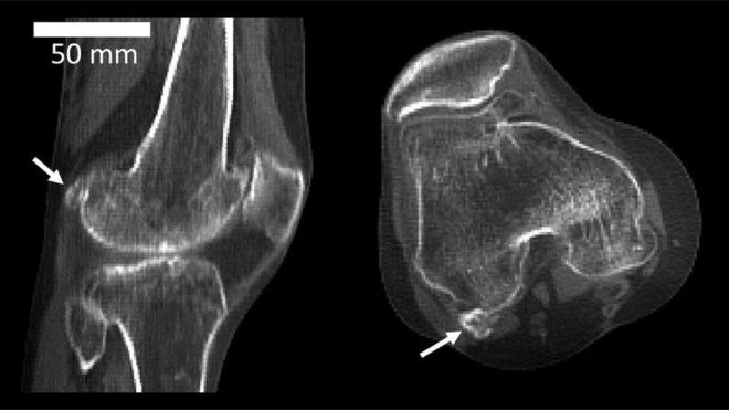 ¿Qué es fabela? el hueso perdido en la evolución que está reapareciendo y que puede ser el causante de tu dolor de rodilla