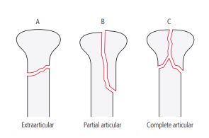 Fracturile extremității distale radiale » Centrul Medical MICROMEDICA