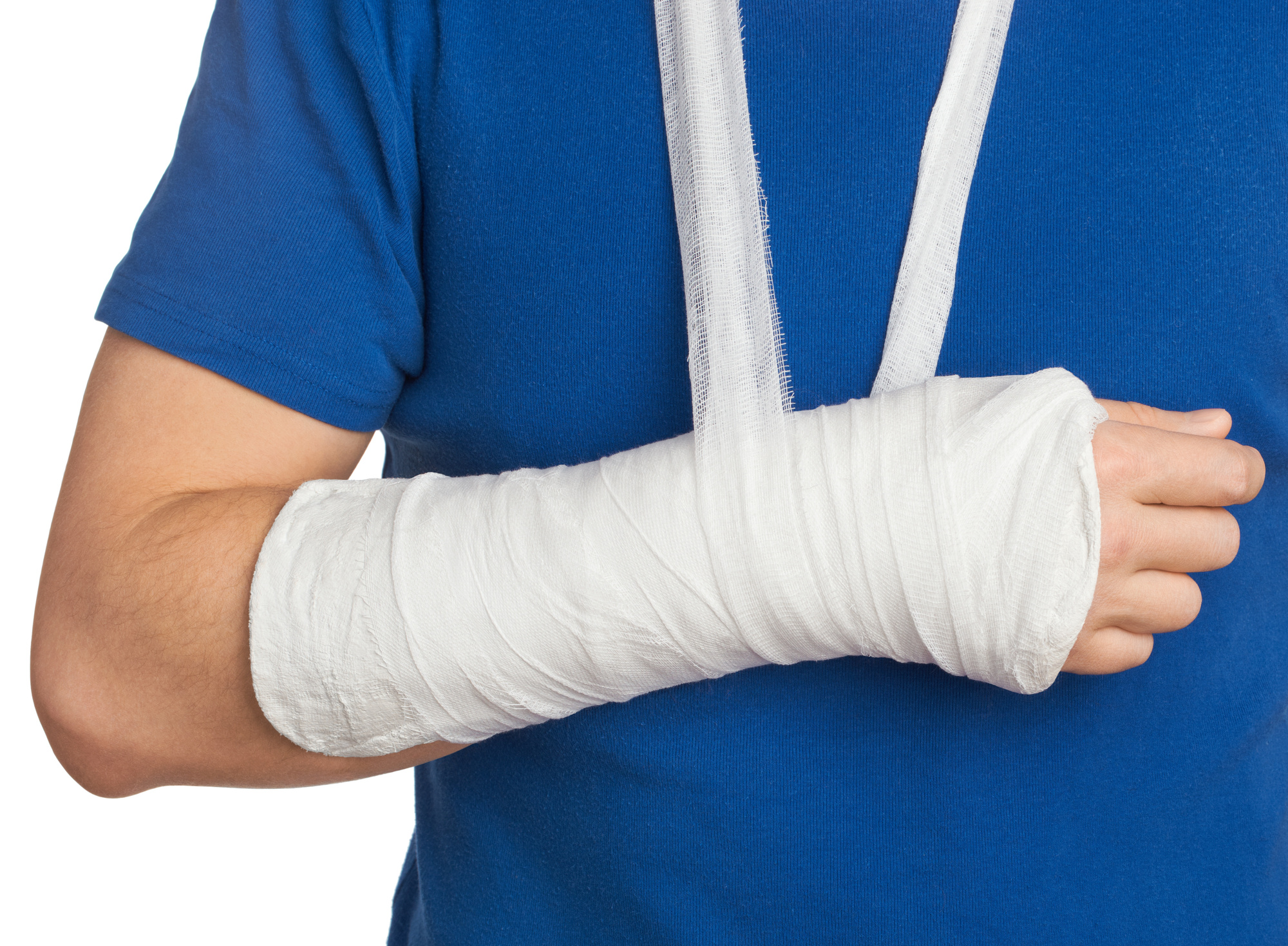La recuperación de una fractura de brazo depende de la parte afectada, la edad y estado de salud del paciente. (Foto Prensa Libre: Shutterstock)