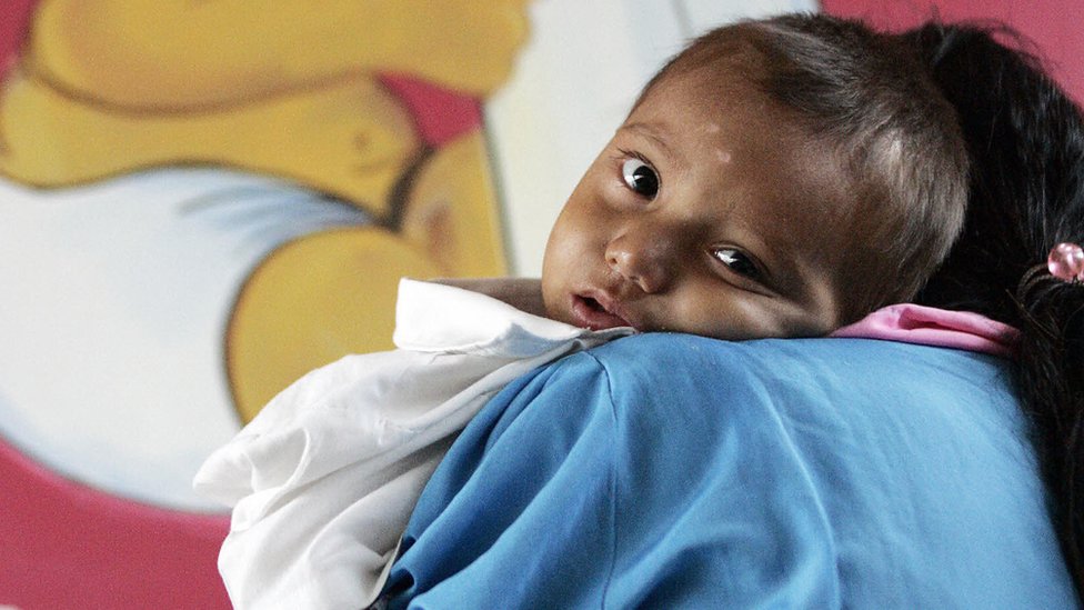 Guatemala lleva años ocupando el primer puesto de desnutrición crónica infantil en América Latina.