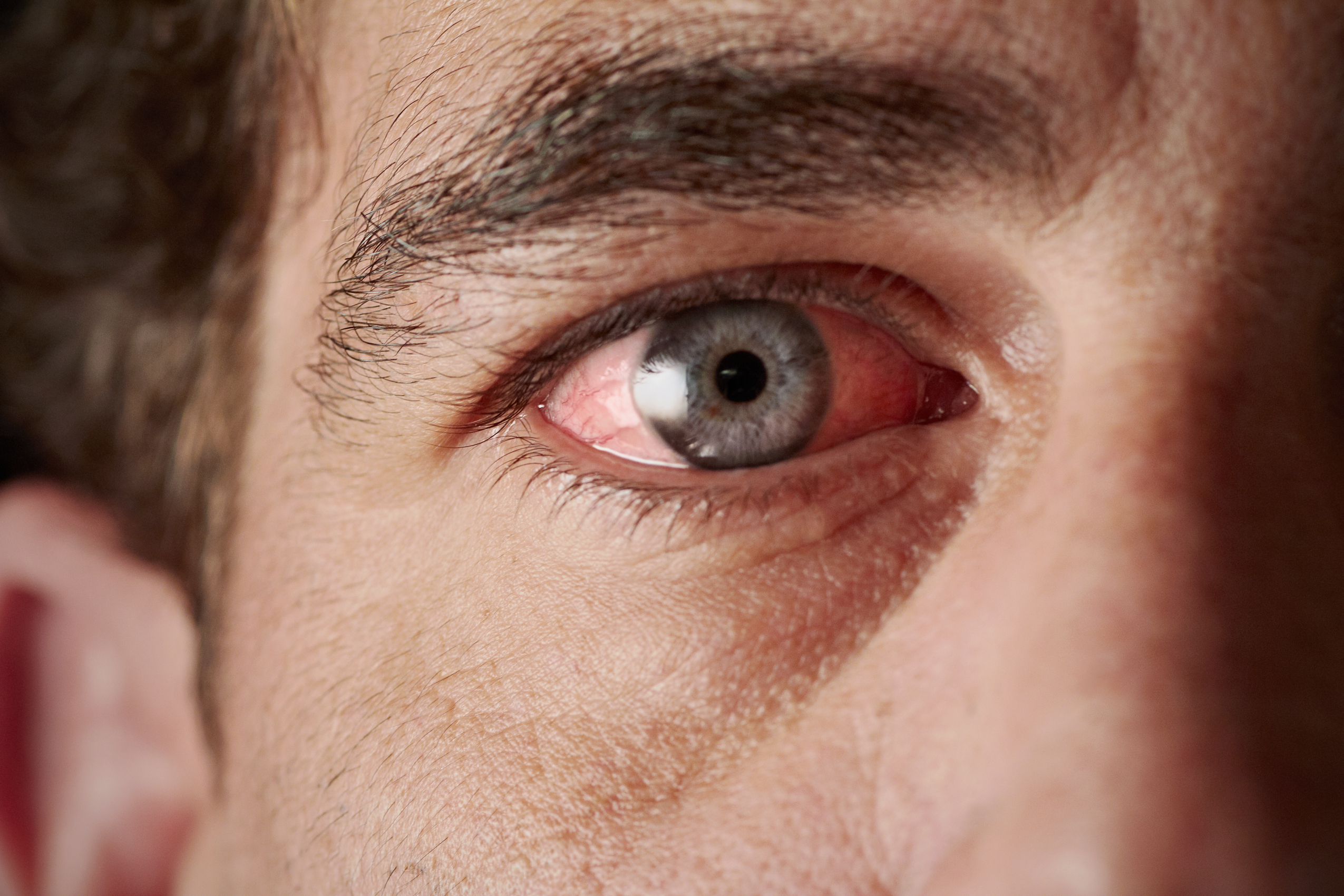La uveítis es una enfermedad que consiste en la inflamación de la úvea, en los ojos. (Foto Prensa Libre: Shutterstock)