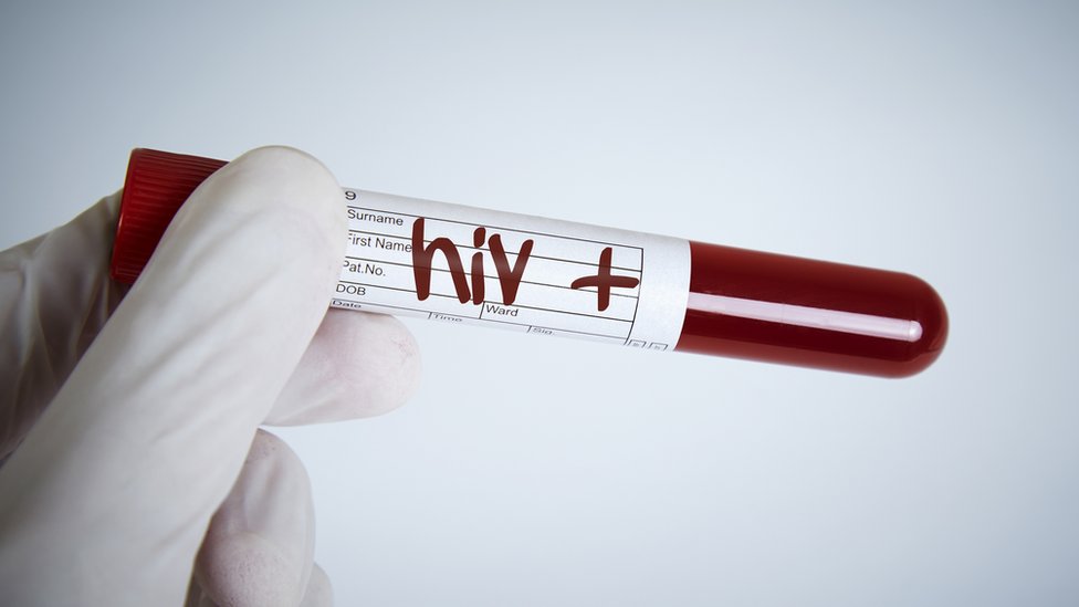 La ONU sigue trabajando para erradicar el VIH (o HIV, en inglés). (Foto Prensa Libre: Getty Images)