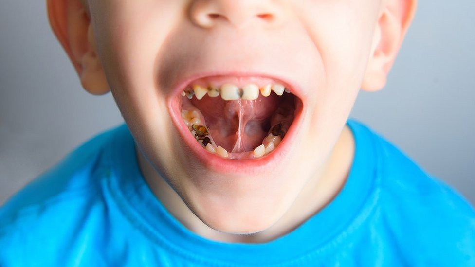 La mayoría de niños del mundo padecen de caries, pero no todos reciben el tratamiento necesario a tiempo. (Foto Prensa Libre: iStock)