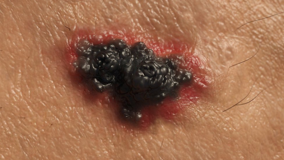 El melanoma se consideraba intratable hasta hace poco. (Foto Prensa Libre: Huw Evans picture agency)
