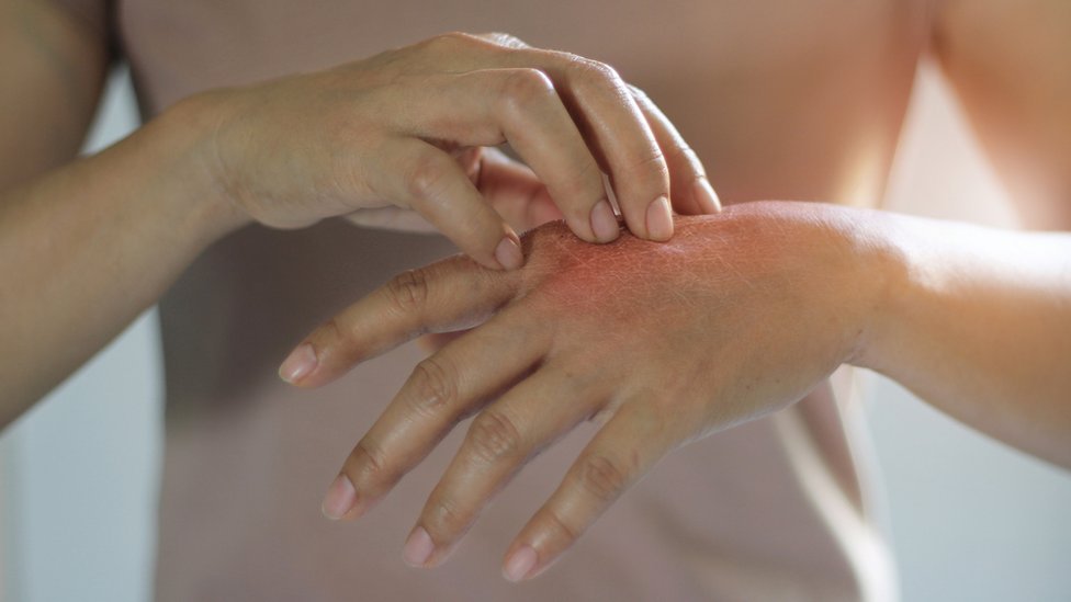 La psoriasis es una enfermedad inflamatoria crónica. (Foto Prensa Libre: Getty Images)