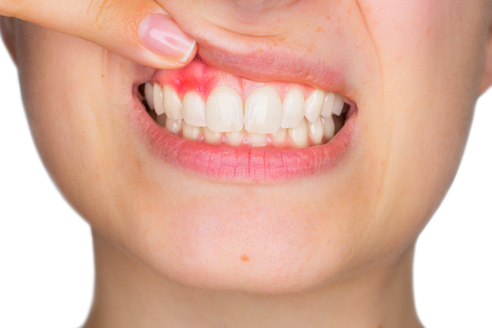 La gingivitis es una enfermedad que provoca inflamación y sangrado de las encías. Puede revertirse en cuestión de meses mejorando su higiene dental y con la ayuda de un profesional. (Foto Prensa Libre: Shutterstock)