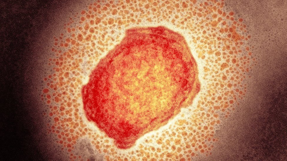 Qué es la “viruela de los monos”, la rara infección que descubrieron en un paciente en Reino Unido