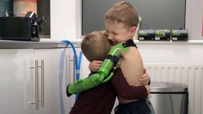 Jacob ay su hermano se abrazaron luego de recibir la prótesis. BEN RYAN