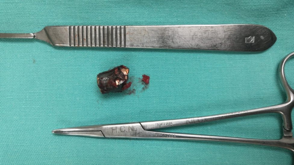 El fragmento de bala que lograron sacarle de la cabeza. Los doctores no pudieron remover algunas esquirlas. (Foto Prensa Libre: BBC Mundo - Ana Gabriela Rojas)