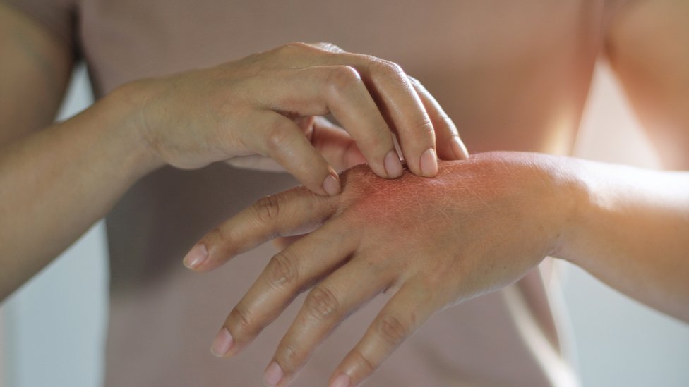 Las personas que tienen dermatilomanía pueden pellizcar o rascar lunares, pecas, marcas o cicatrices para suavizarlos o perfeccionarlos.