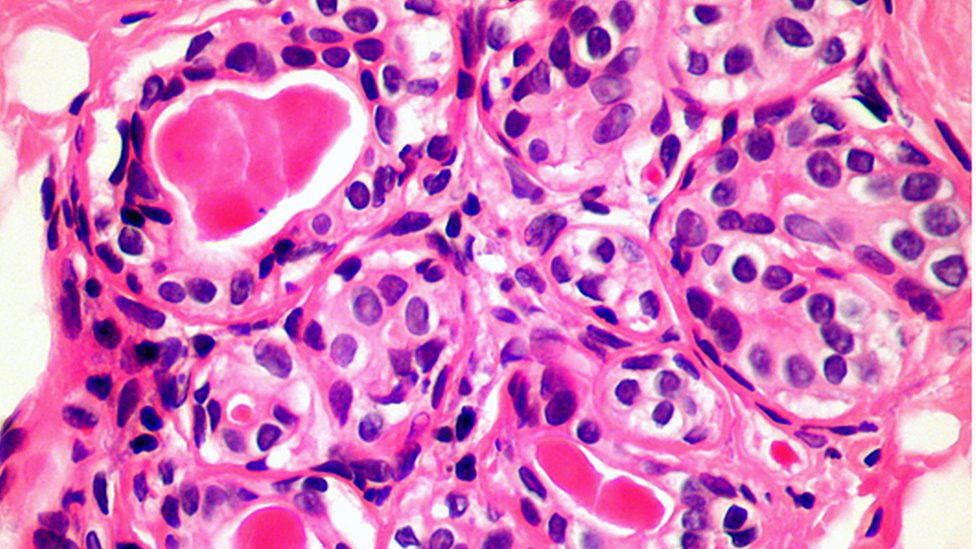 La nueva técnica podría matar una amplia gama de células cancerosas, incluidas las de mama y próstata. SCIENCE PHOTO LIBRARY