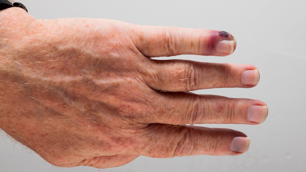 La septicemia es causada cuando el sistema inmune entra en colapso y, en lugar de combatir una infección, también comienza a atacar otras partes del cuerpo. GETTY IMAGES