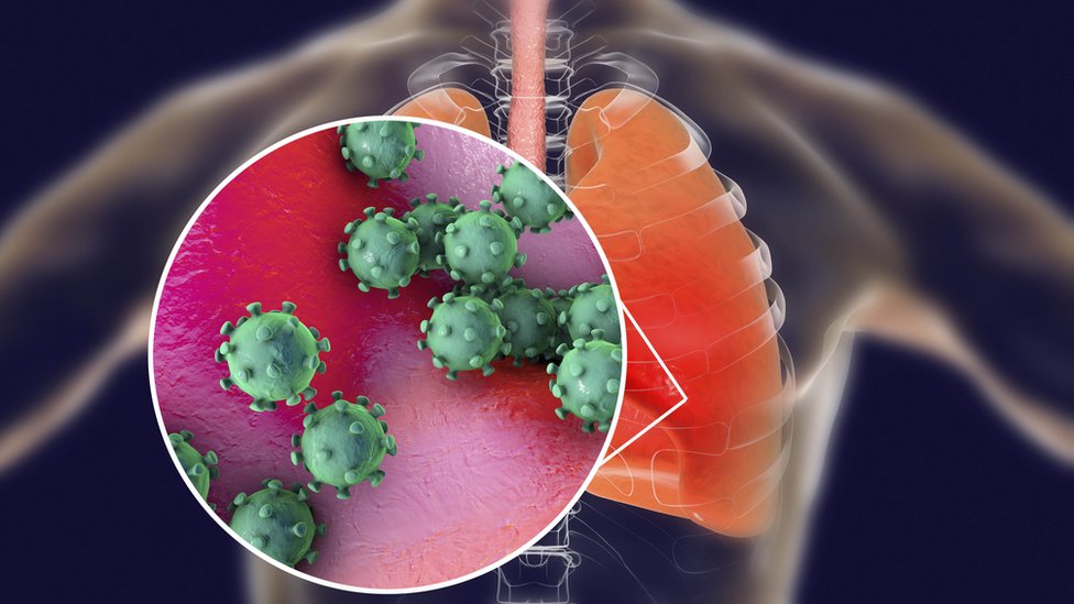 El coronavirus puede causar lesiones severas en los pulmones. GETTY IMAGES