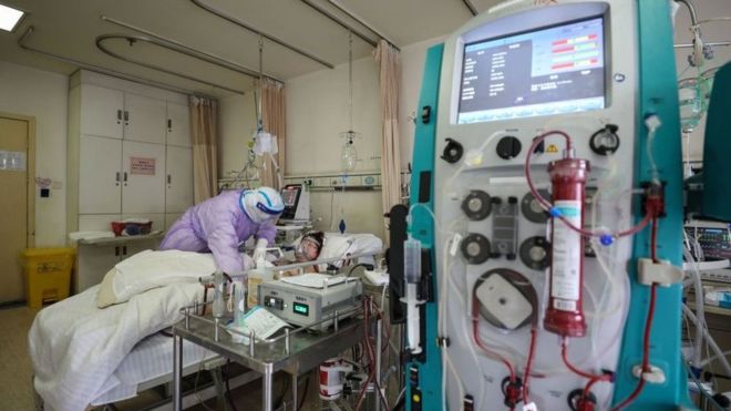 La respiración extracorpórea se empezó a aplicar a pacientes con covid-19 en China. GETTY IMAGES