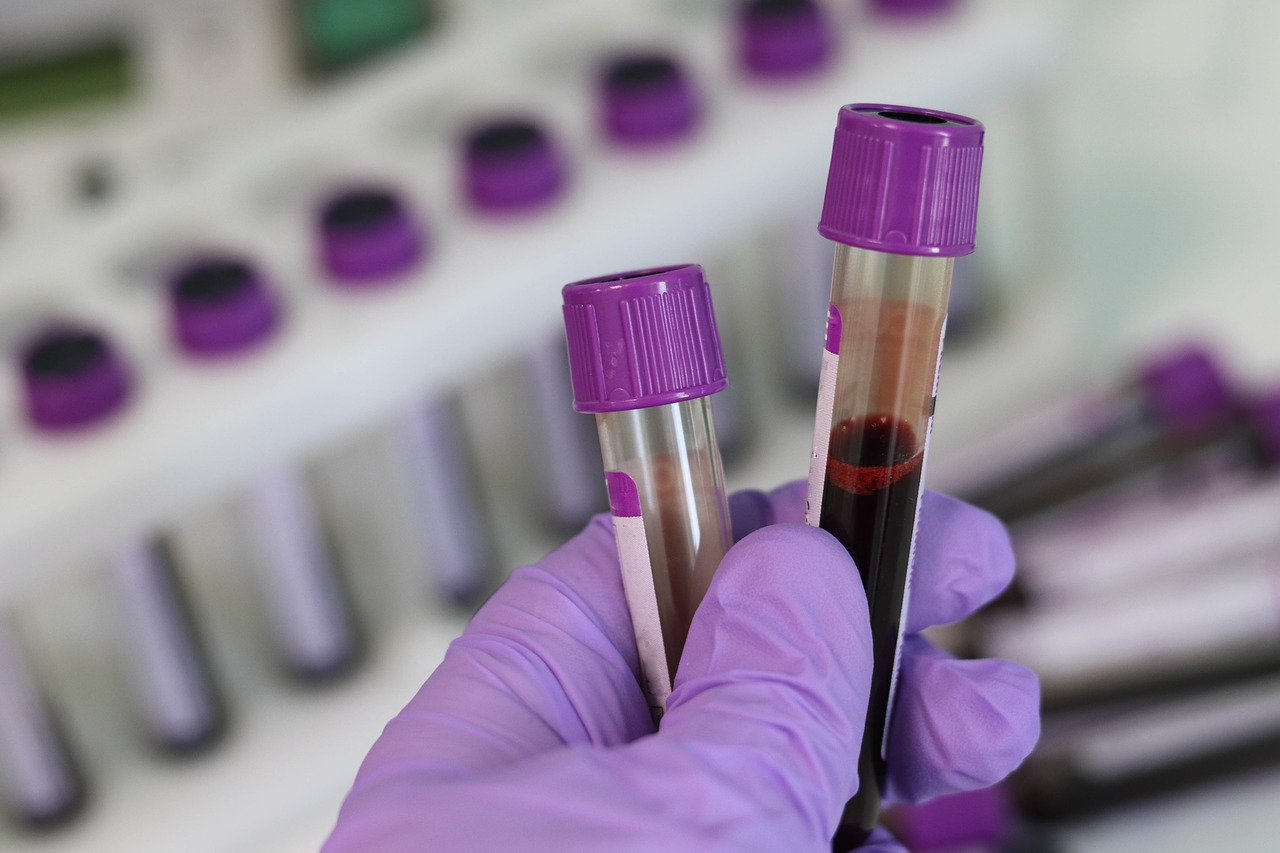 Estudio realizado en China indica que personas con sangre de tipo A podrían ser más propensas a contagiarse de covid-19. (Foto Prensa Libre: Pixabay).