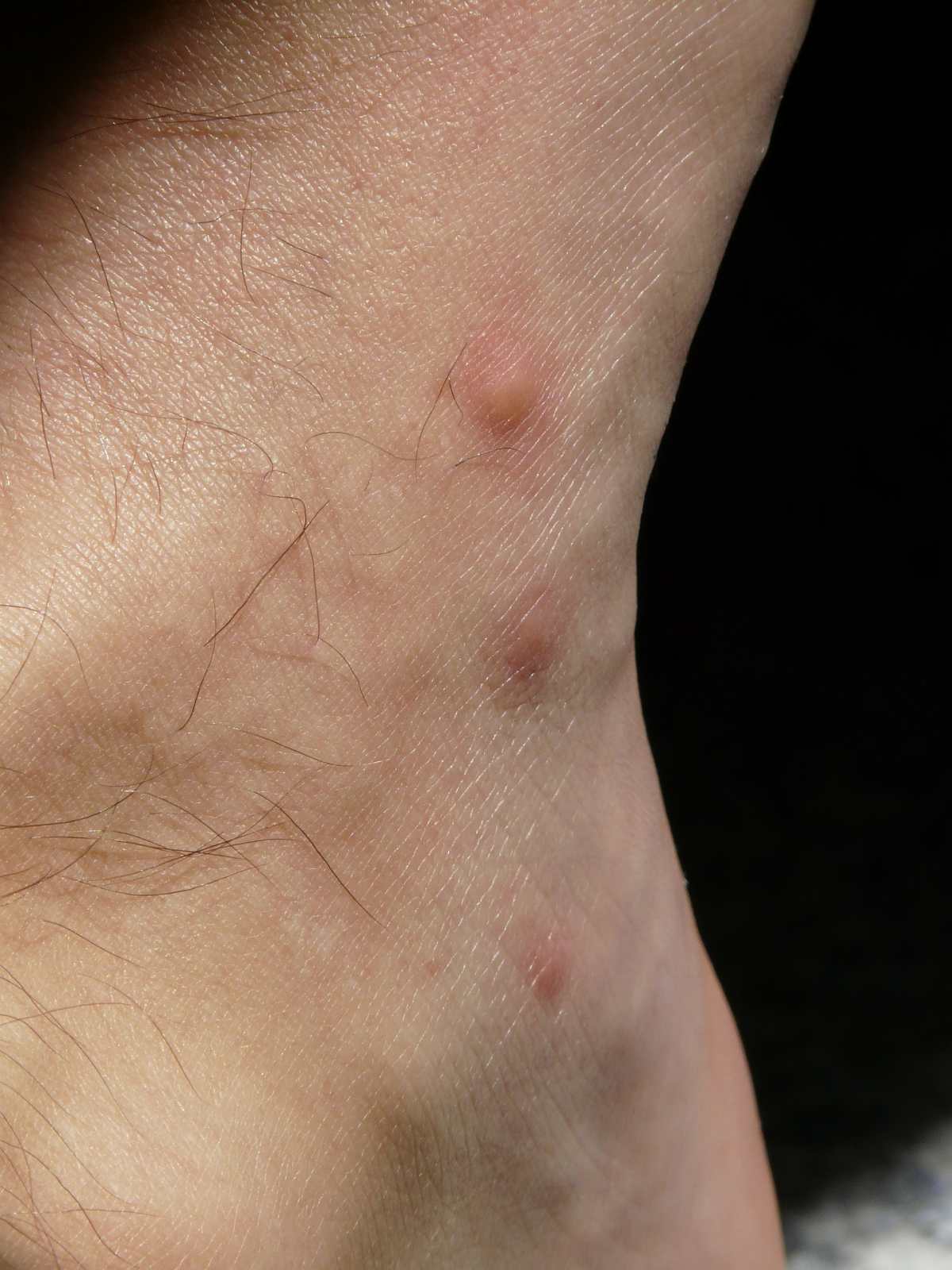 Coronavirus: ¿Las lesiones en la piel podrían ser síntomas del coronavirus?