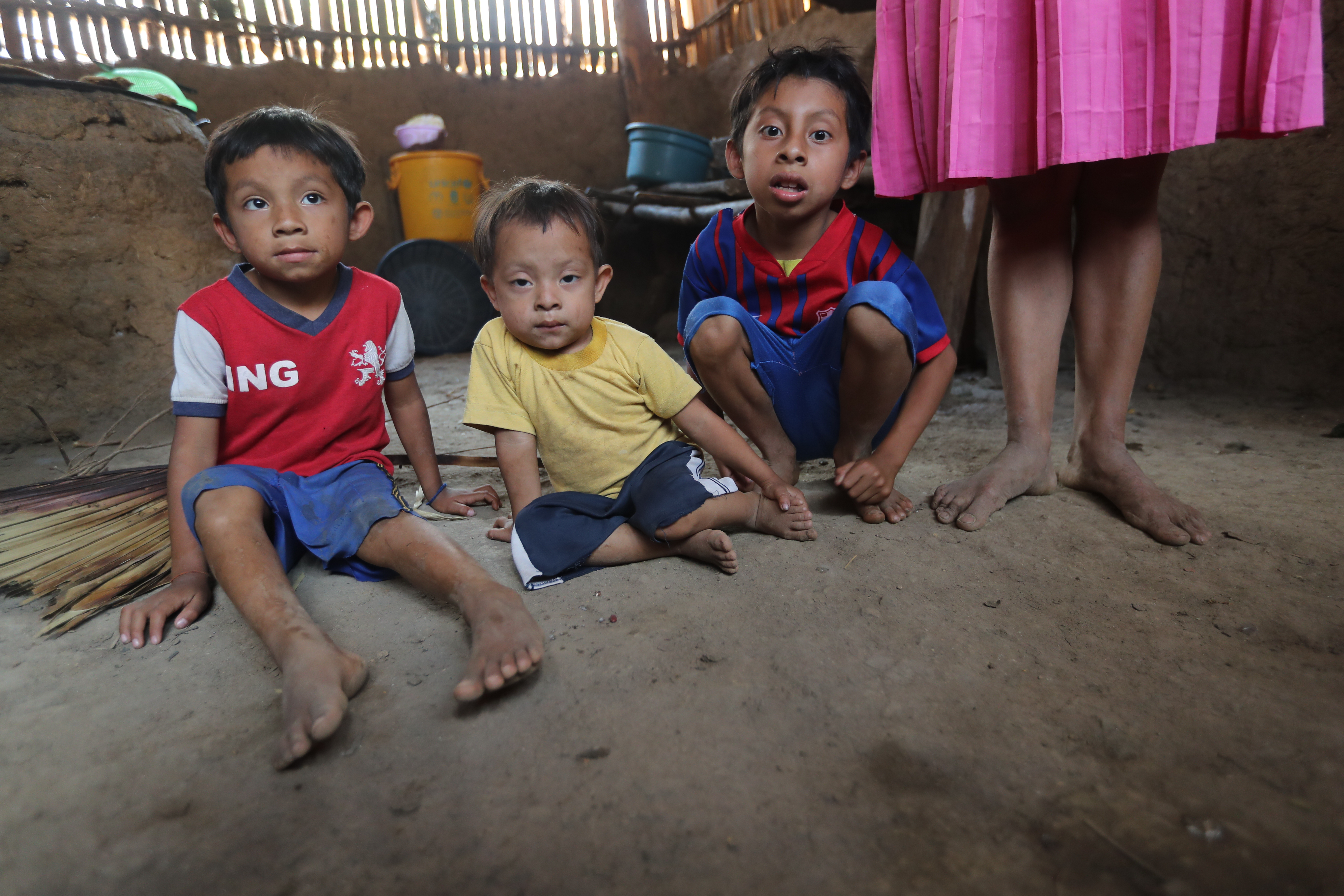 La desnutrición aguda se ensaña principalmente con la niñez del Corredor Seco.  (Foto Prensa Libre: Érick Ávila) 
