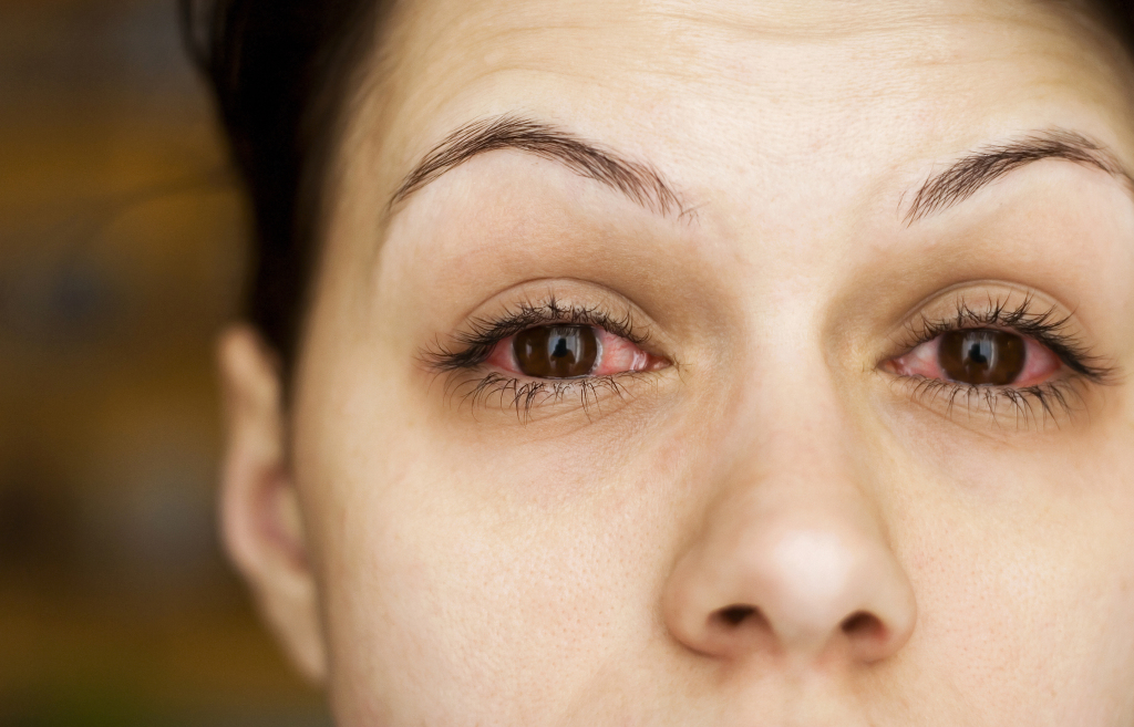 La inflamación en los ojos podría estar asociada a diferentes causas, incluso el coronavirus.  (Foto Prensa Libre: Shutterstock).