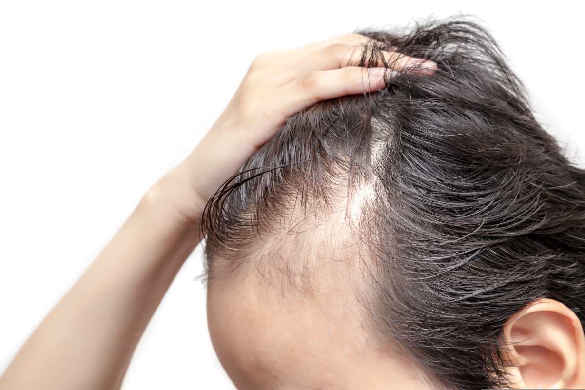 Alopecia: qué relación tiene con la nutrición y cuáles son sus variantes