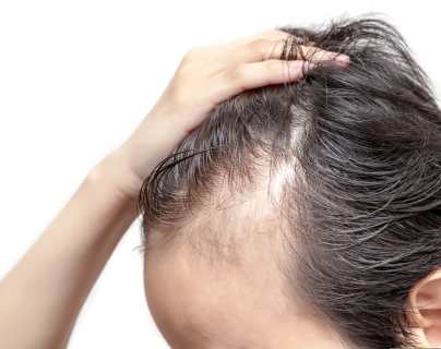 Alopecia: qué relación tiene con la nutrición y cuáles son sus variantes
